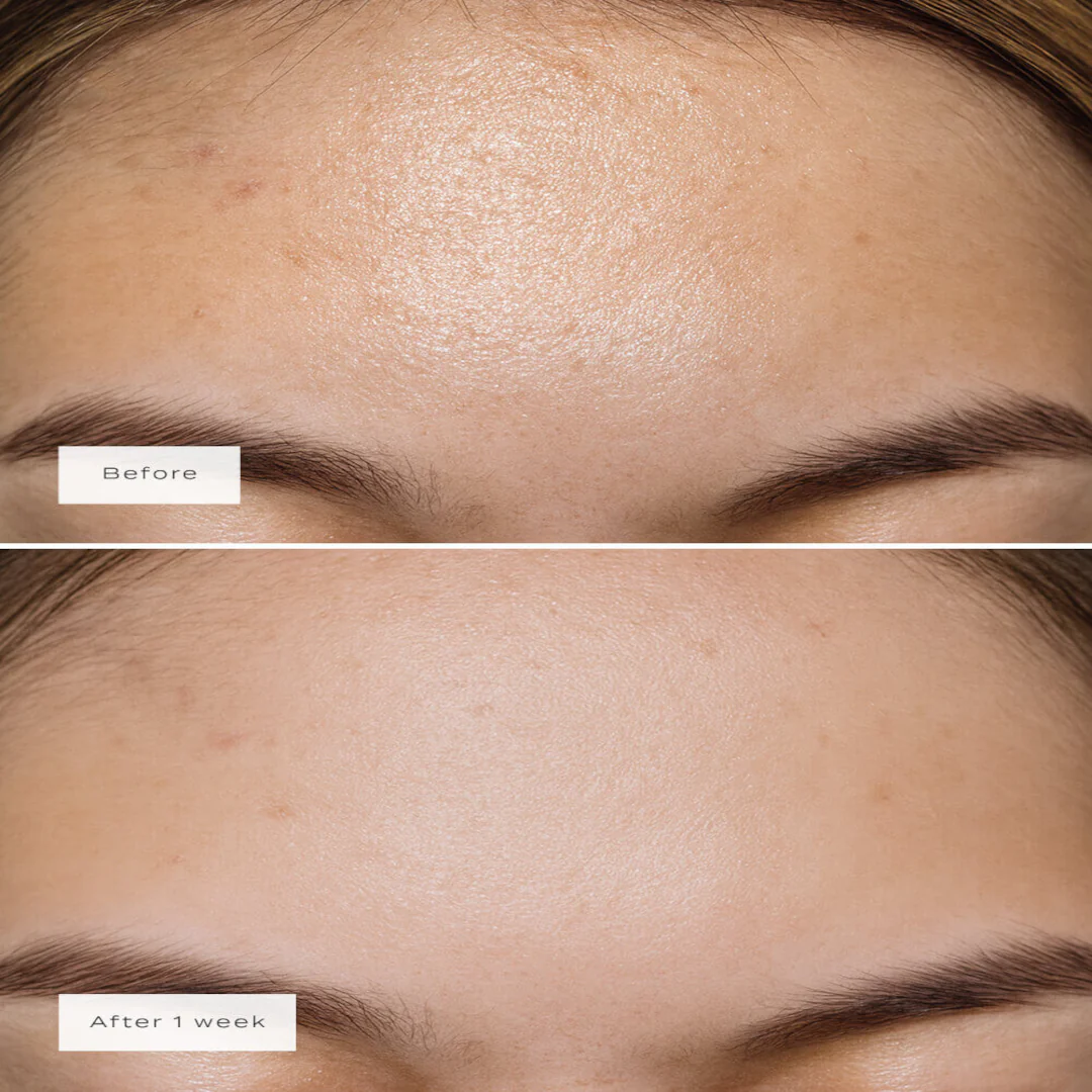 Vue Forehead Patches - Image 5